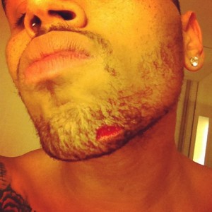 Chris Brown, Drake Fight - Bottle Injury - Twitter Picture